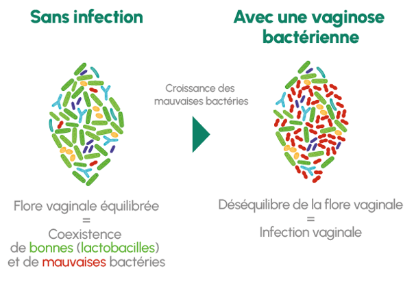 Flore vaginale saine et flore vaginale déséquilibrée
